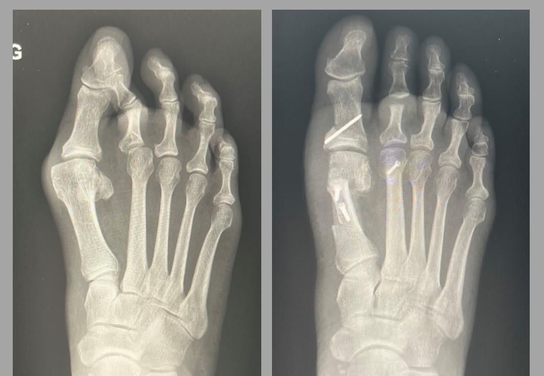 Severe hallux valgus with second toe overlap — before and after