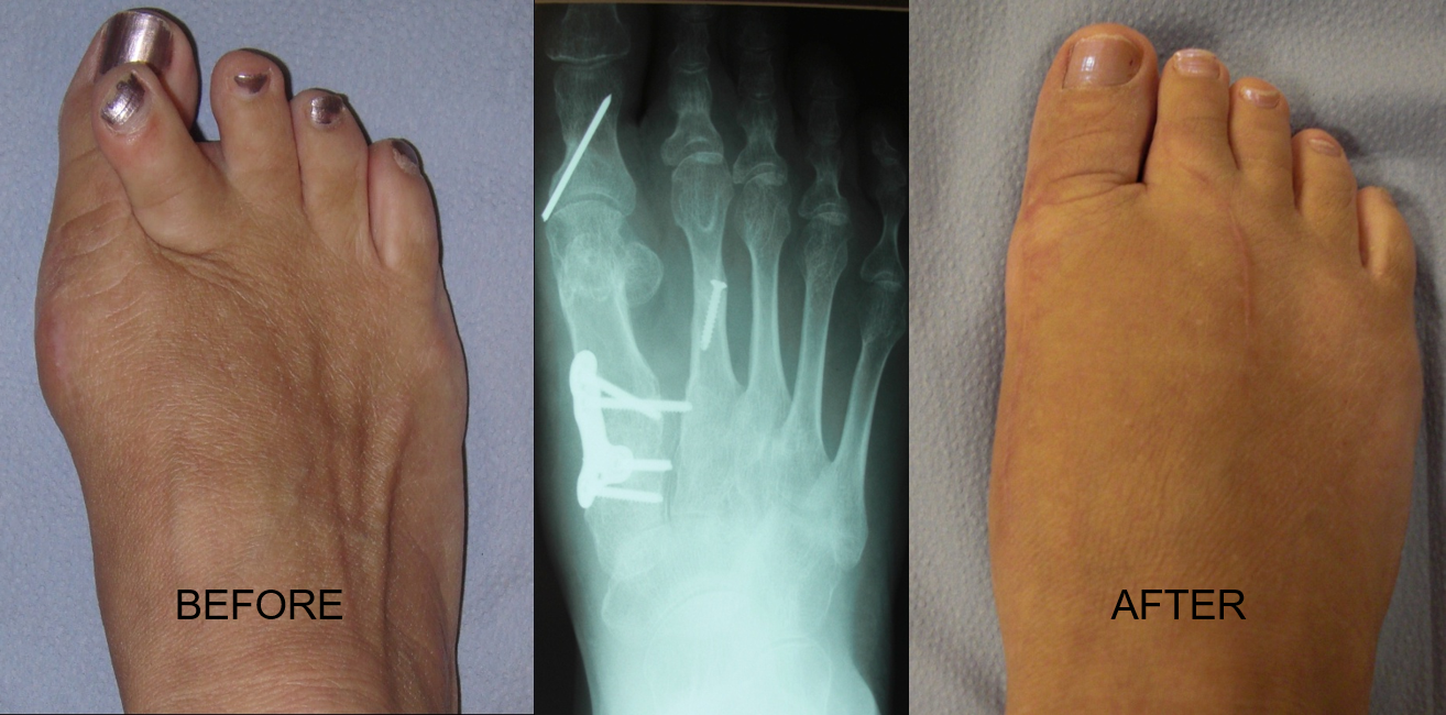 Before, x-ray fixation and final result — before and after
