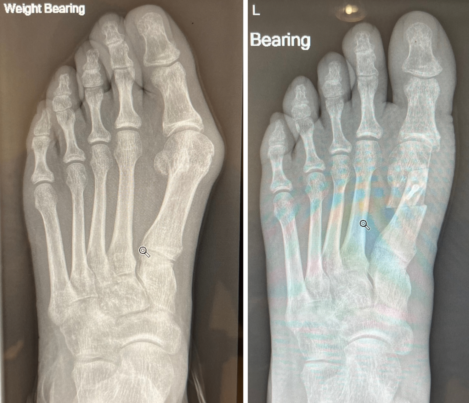 Bunion correction — three weeks post-op — before and after