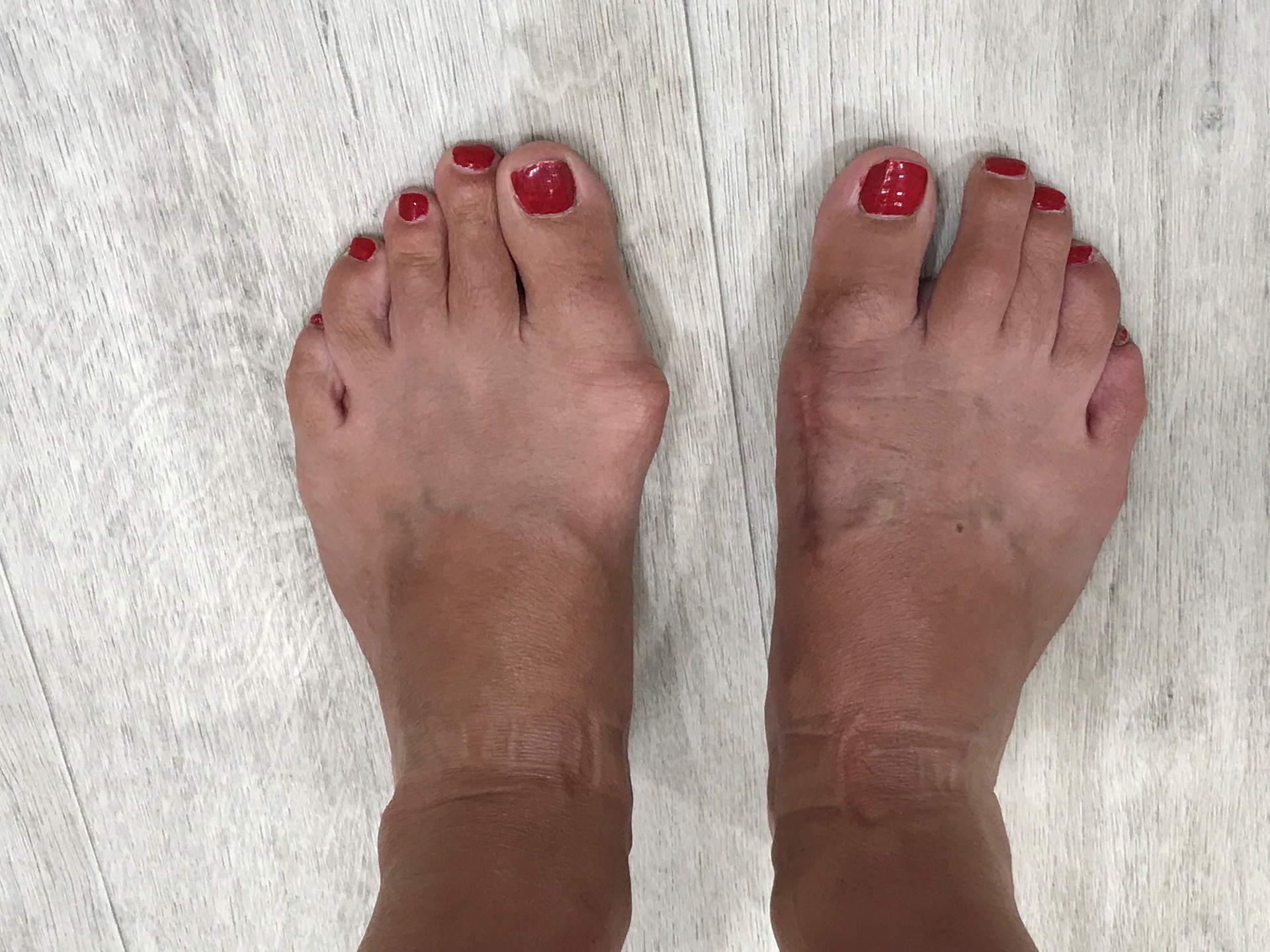 Bilateral bunion correction — before and after