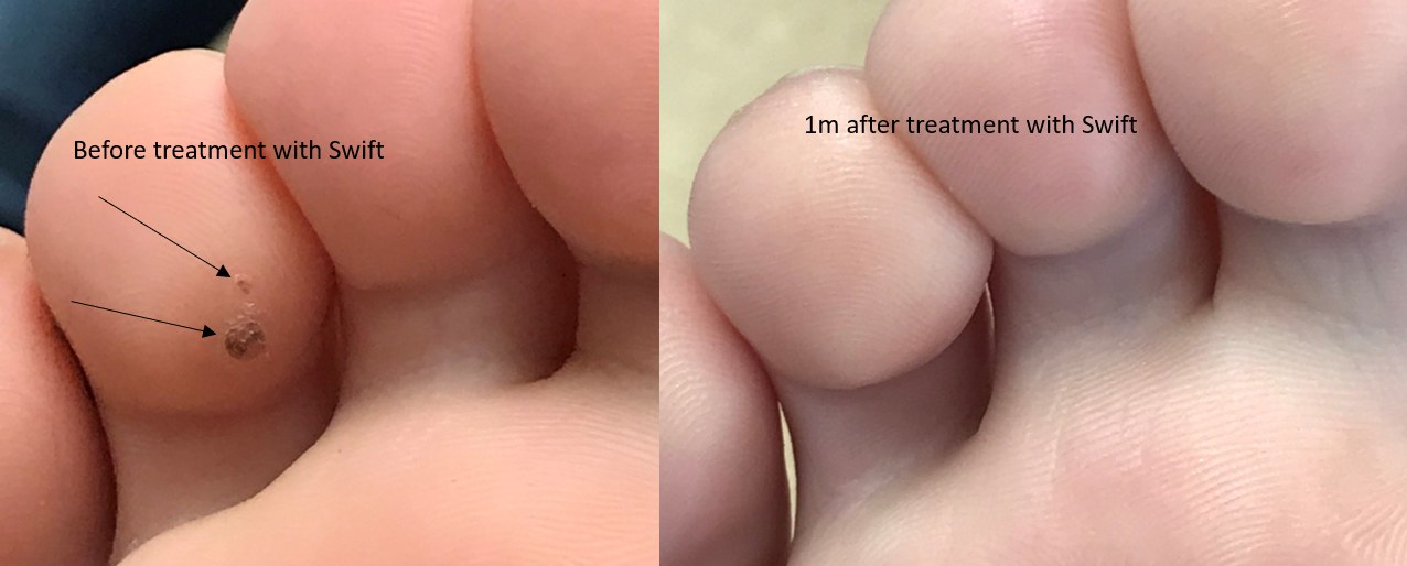 Verrucae on the toes