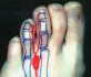 Clinical illustration marking the location of a Morton's neuroma in the interspace