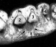 MRI scan of the forefoot demonstrating a Morton's neuroma between the metatarsal heads