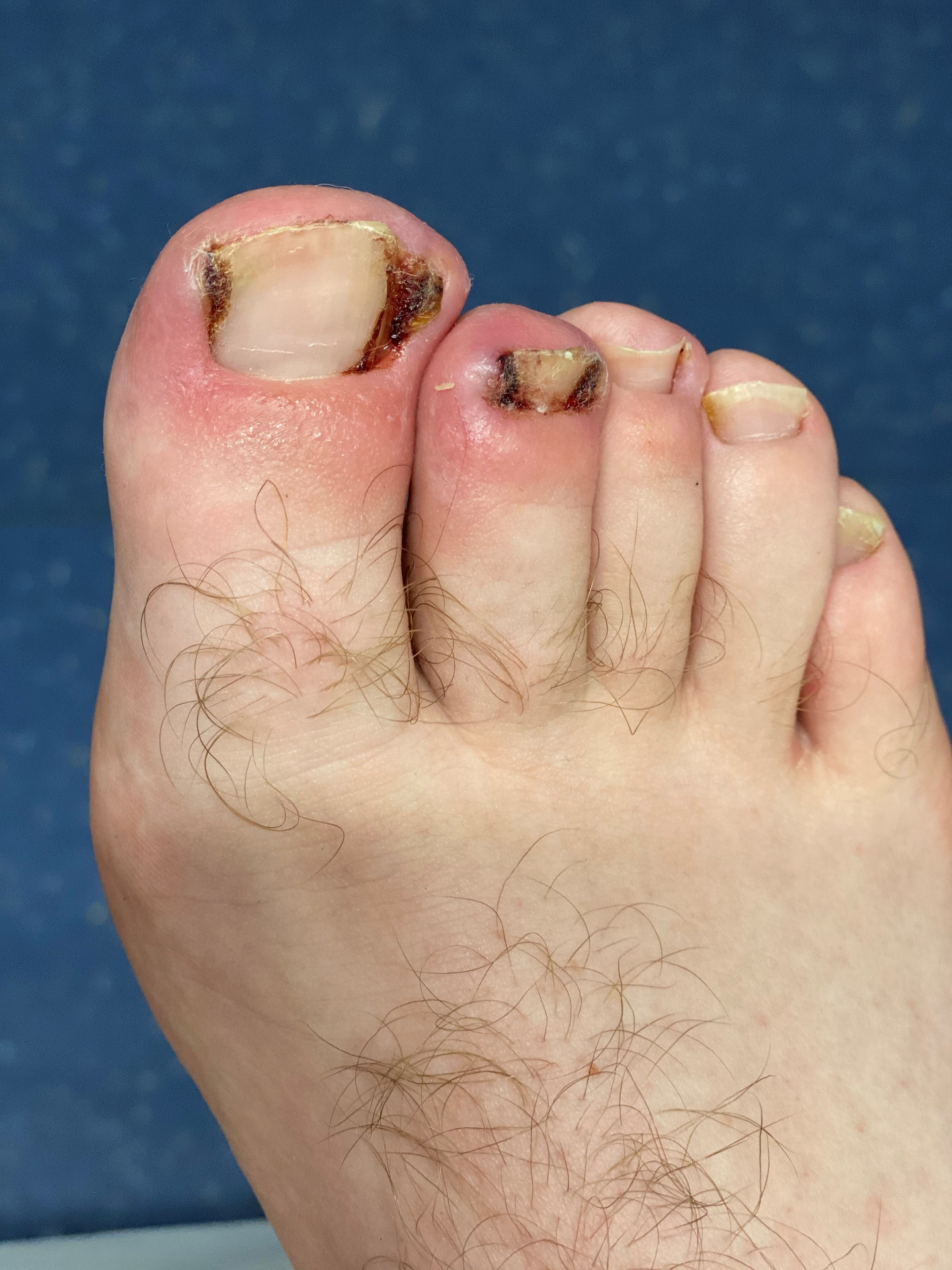 Advanced bilateral ingrown toenails with infection and hypergranulation tissue
