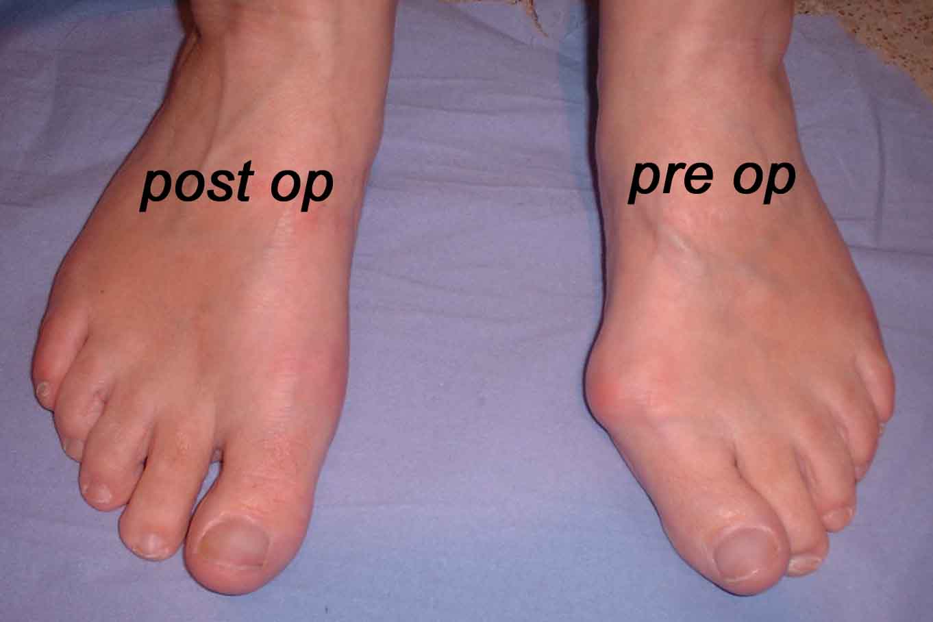 Standing view — pre and post-op — before and after