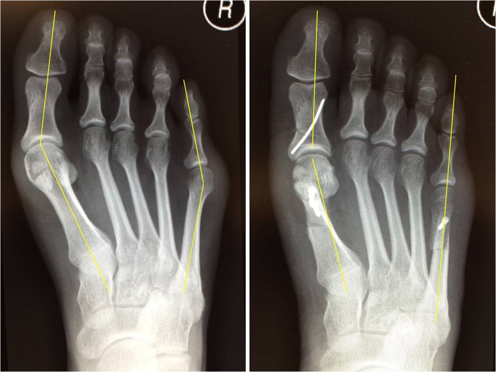 Bunion with tailor's bunion (bunionette) — before and after