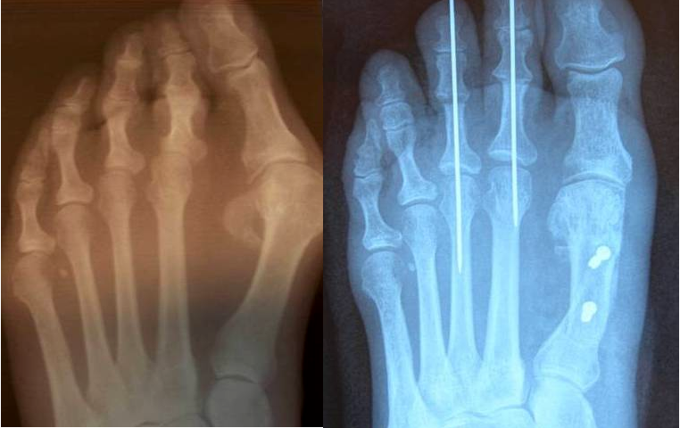 Bunion correction with temporary K-wires — before and after