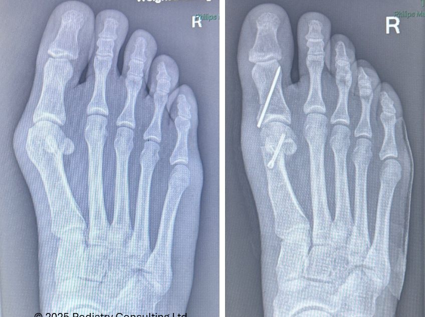 Moderate bunion — scarf & Akin osteotomy — before and after
