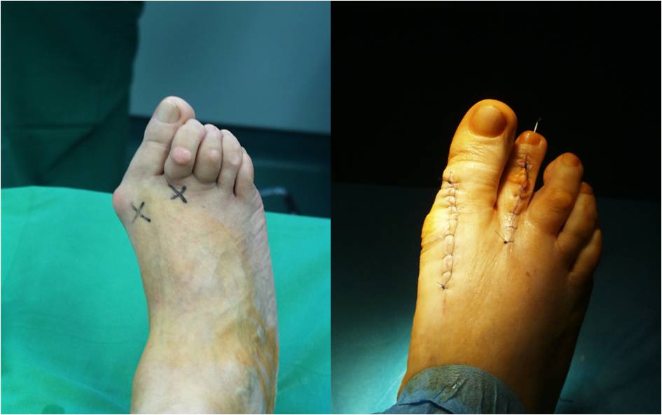 Immediately after surgery — before and after