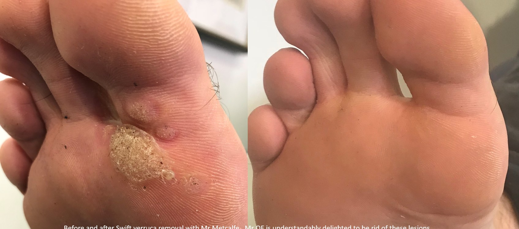 Verruca on the forefoot before treatment